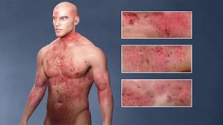 Atopic Dermatitis eczema From the Inside Out [upl. by Weil110]