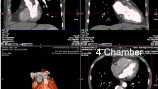 Acute Coronary Syndrome DETAILED Overview MI STEMI NSTEMI [upl. by Cyndie427]