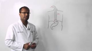 Understanding Esophageal Cancer [upl. by Gwyn831]