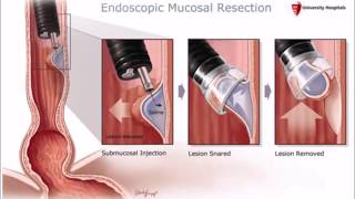 Esophageal Cancer Surgery  The Nebraska Medical Center [upl. by Sivam491]