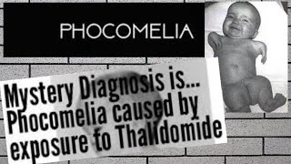 What is Phocomelia its cause and treatment [upl. by Kutzenco]