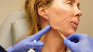 Jawline Correction with Filler with Dr Janowski [upl. by Amend]