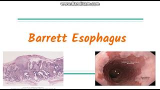 Barrett Esophagus [upl. by Myrlene]