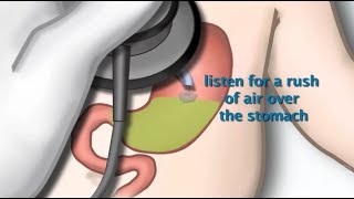 Tube Feeding Methods Continuous Cyclic Intermittent Bolus [upl. by Hanni566]