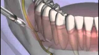 Malameds Local Anesthesia 11 Supplemental Injection Techniques [upl. by Ennairrac]