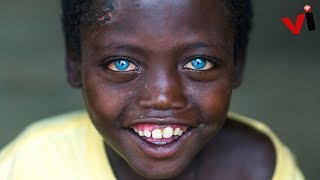 5 Stunning People With Waardenburg Syndrome [upl. by Svend]