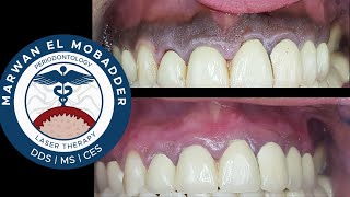 Tips for a Successful Gingival Depigmentation [upl. by Ezitram600]