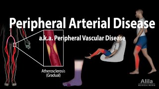 Peripheral artery disease Pathophysiology Causes Symptoms Diagnosis and Treatments Animation [upl. by Hacceber]